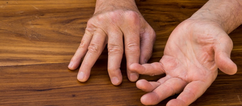 best psoriatic arthritis treatment