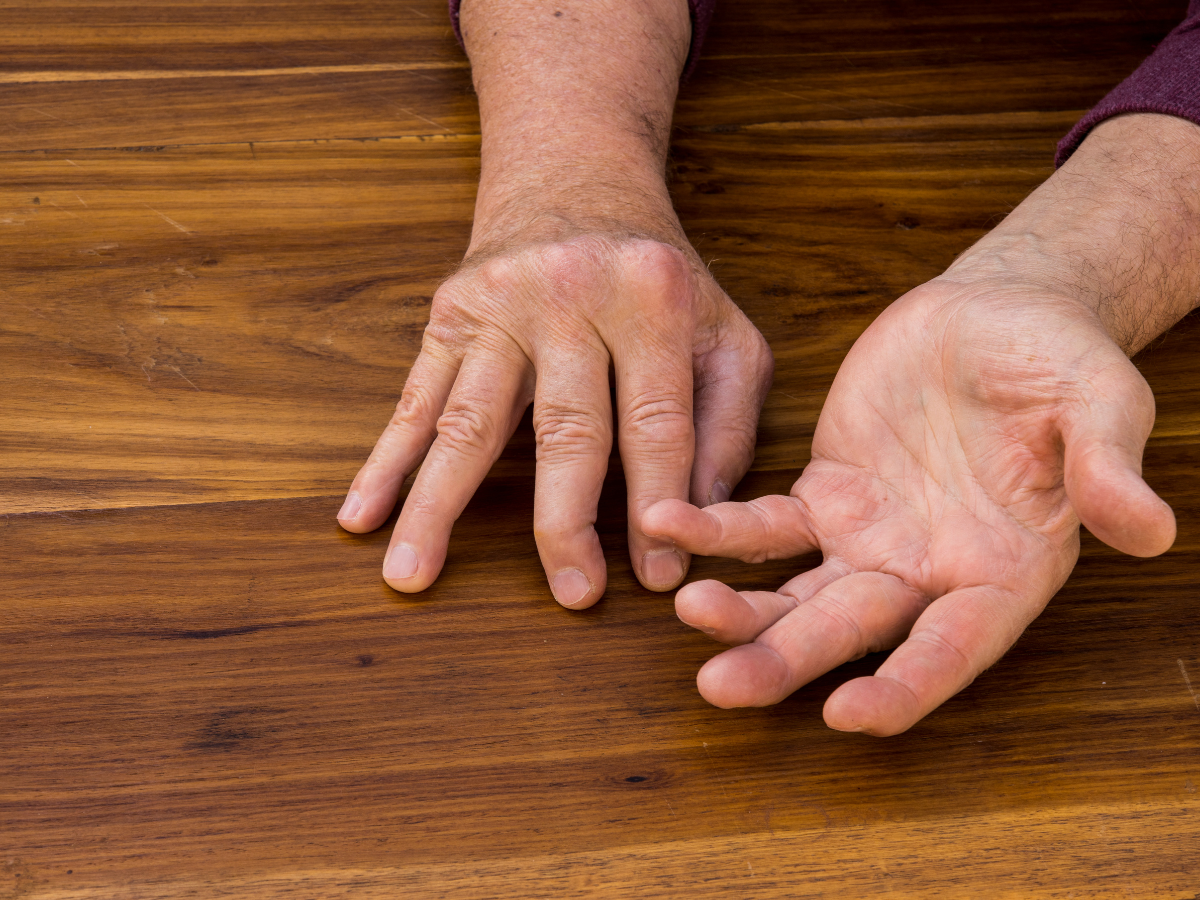 best psoriatic arthritis treatment