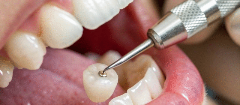 crowns and bridges for teeth