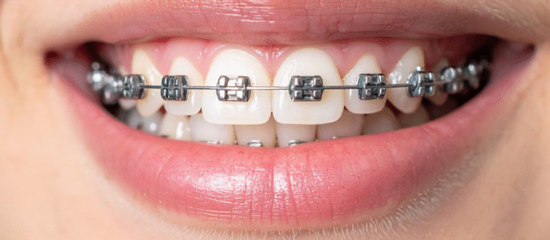 Orthodontic Treatment