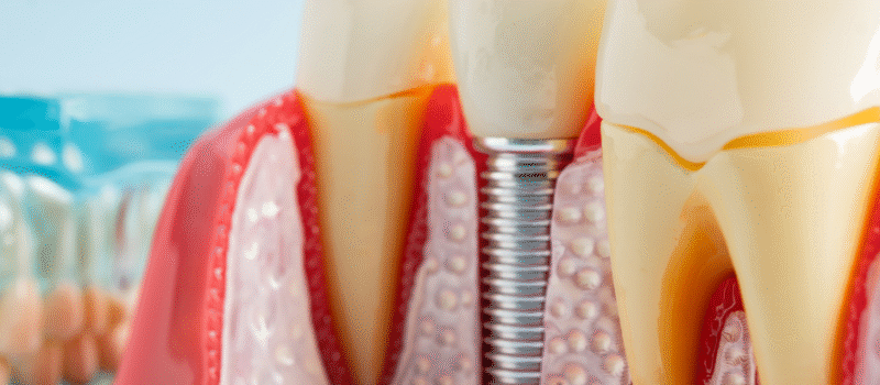 Dental Implants