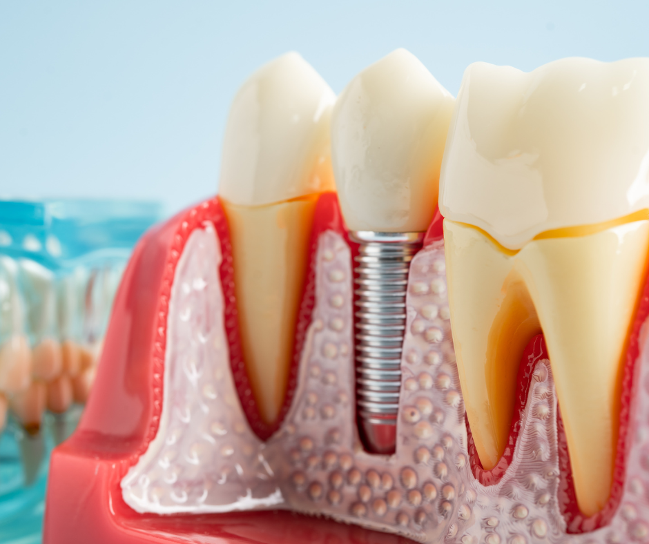 Dental Implants